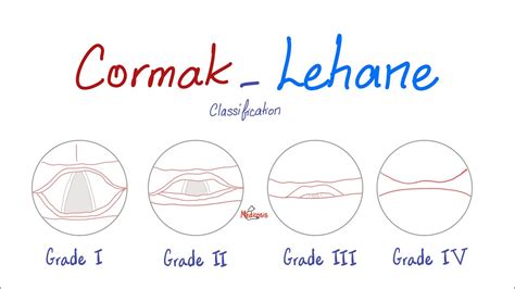 Cormak-Lehane Classification (Grades) for Airway Management and ...