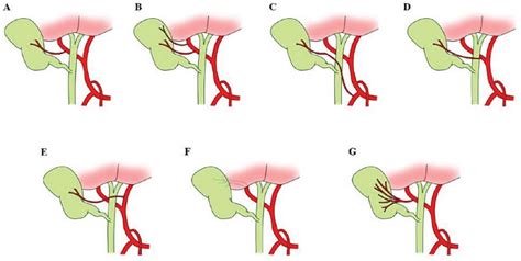 Figure 1 from Cystic Artery Variations and Associated Vascular ...