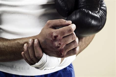 Physical Therapy After a Boxer's Fracture