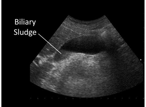 Biliary sludge - Alchetron, The Free Social Encyclopedia