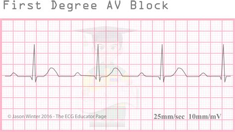 ECG Educator Blog : Heart Blocks