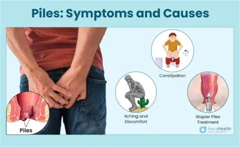 Piles - Symptoms, Meaning, Images, Causes and Types