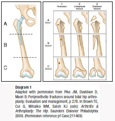 Periprosthetic fractures of the femur associated with hip arthroplasty