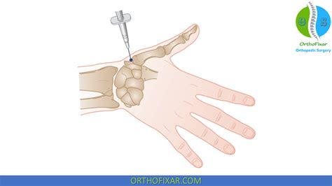 CMC Joint Injection | OrthoFixar 2024