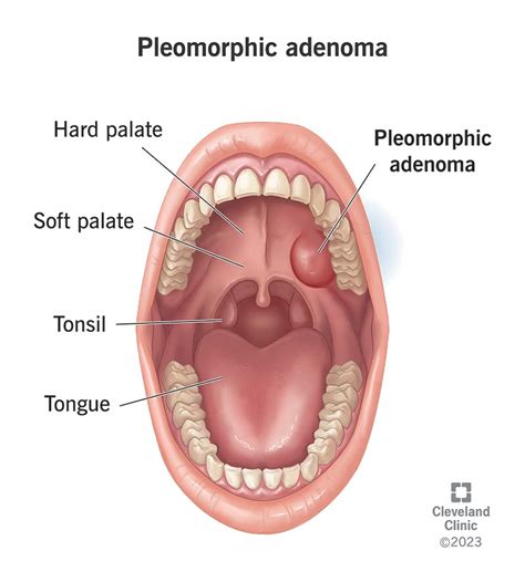 Pleomorphic Adenoma: Symptoms, Causes & Diagnosis