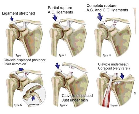 Rockford Classification AC separation anatomy acromioclavicular - ALiEM