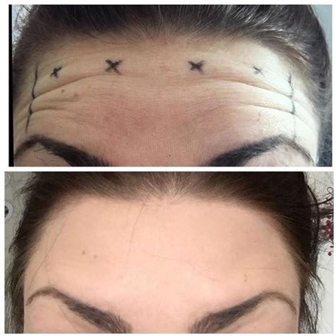 botox injection forehead wrinkles before after (1) » Facial Injections ...