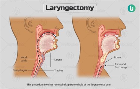 Laryngectomy: Procedure, Purpose, Results, Cost, Price