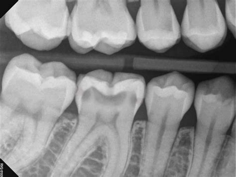 LR6 Mesial, Occlusal and Distal Decay – 10K Teeth