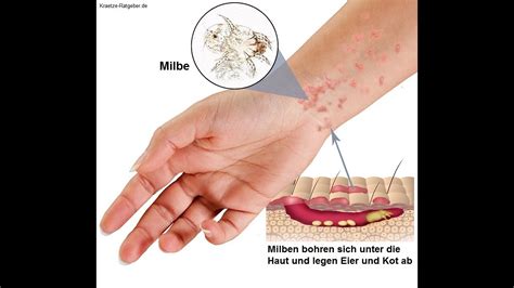 Alarm Die Krätze ist zurück 2017 - YouTube