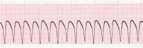 Ventricular Rhythms