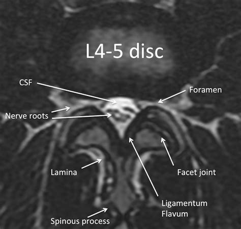 Anatomy Of The Lumbar Vertebrae: Normal Anatomy E-Anatomy, 50% OFF