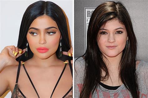 Kylie Jenner before surgery: Plastic surgeon gives verdict on starlet's ...