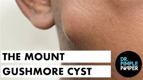 A Rubber Ball Cyst in the Cheek - Cystactular Cysts - Dr. Pimple Popper