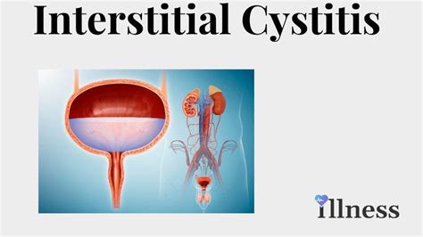 Interstitial Cystitis (IC) : Overview, Causes, Symptoms, Treatment ...