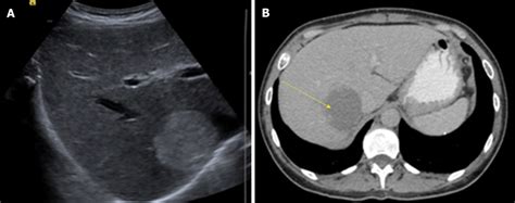 Hepatic Hemangioma Ultrasound