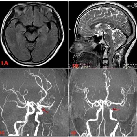 A-D). Preoperative MRI and MRA images. A& B are preoperative MRI ...