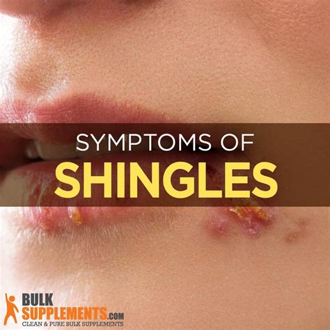 Shingles (Adult Chickenpox): Causes, Symptoms & Treatment