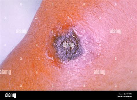 Anthrax Disease