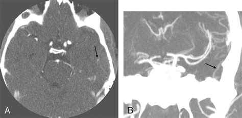 Spontaneous Resolution of Posttraumatic Middle Meningeal Artery ...