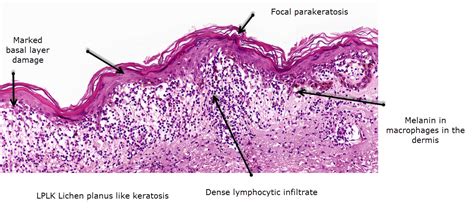 Dermatopathology Made Simple - Inflammatory: Lichenoid / Vacuolar ...