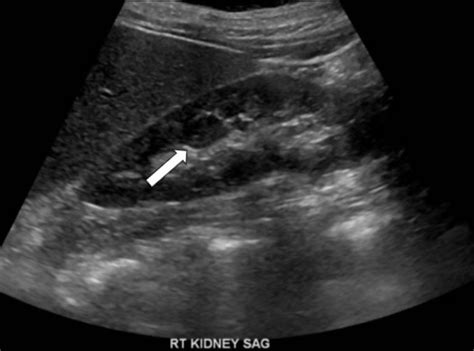 Kidney Ultrasound Tumor