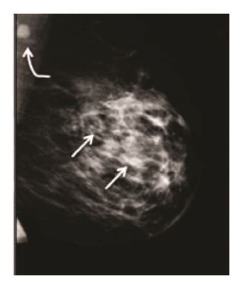 Mammogram images of a fatty breast and a heterogeneously dense breast ...