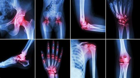 What Does Arthritis Pain Feel Like? | Everyday Health