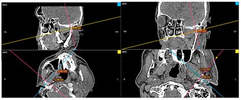 Pterygoid Plate Fracture