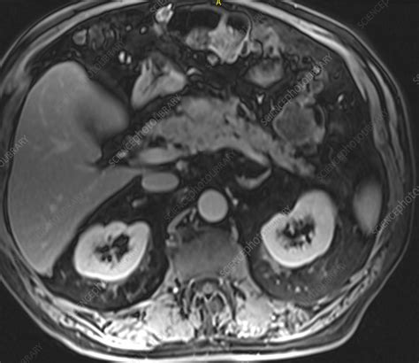 Pancreatitis, MRI - Stock Image - C039/3177 - Science Photo Library