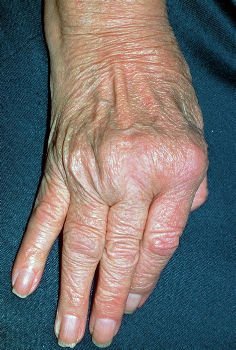 Rheumatoid Arthritis Of Hand With Ulnar Deviation Photograph by Science ...