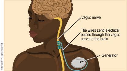 Vagus Nerve Stimulator Therapy for Epilepsy (for Parents) | Nemours ...