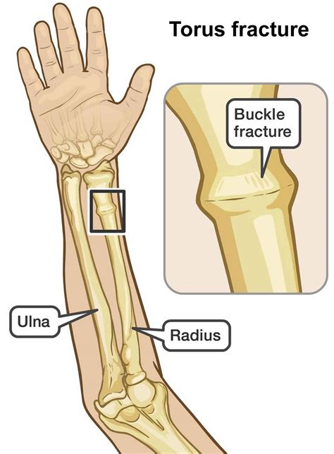 Buckle fracture causes, symptoms, diagnosis & treatment