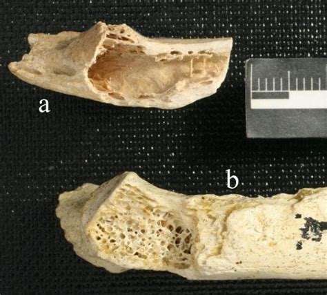 Hallan el cáncer de huesos más antiguo en un Neanderthal de hace 120. ...