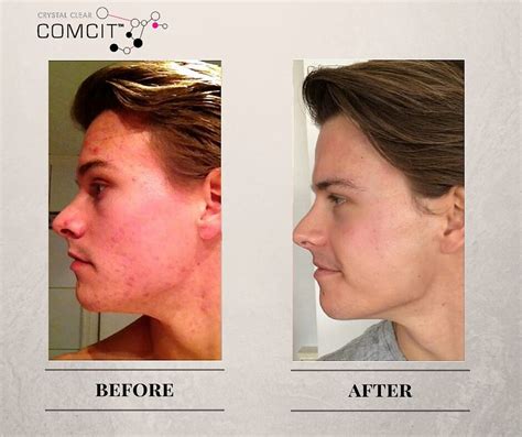 COMCIT Microneedling - skin rejuvenation - Lux Laser and Beauty Clinic