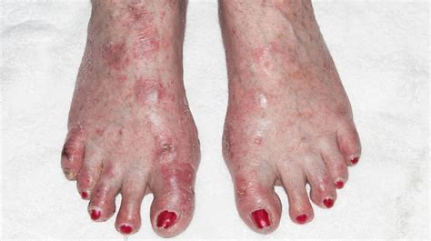 Eczema On Feet: Types, Symptoms, Causes, And More | atelier-yuwa.ciao.jp