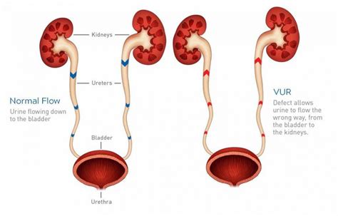 Hidronefrosis: Penyebab, Gejala, dan Pengobatan