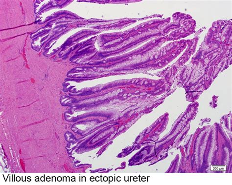 Pathology Outlines - Villous adenoma