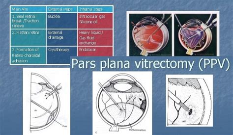 Vitrectomy Membrane Peeling