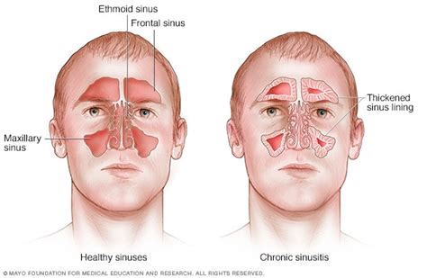 Chronic sinusitis - Symptoms and causes - Mayo Clinic