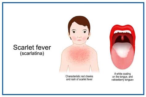 Scarlet fever symptoms – Costamedic