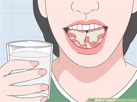 Easy Ways to Treat Geographic Tongue: 9 Steps (with Pictures)