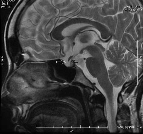 Sagittal t1 weighted MRI-brain image shows sella turcica is replaced by ...