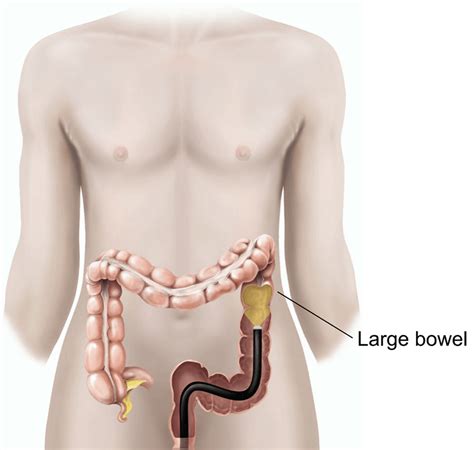 Flexible sigmoidoscopy | healthdirect