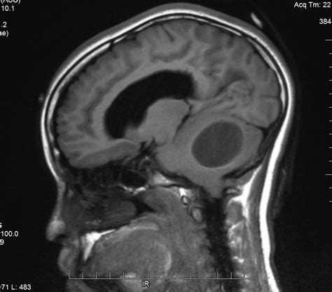 Pilocytic Astrocytoma | Consultant360