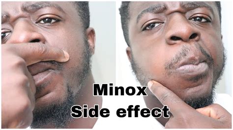 slsi.lk - how long for sulfatrim to work | Are minoxidil side effects ...