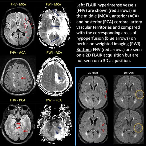 Estimating Perfusion Deficits in Acute Stroke Patients Without ...