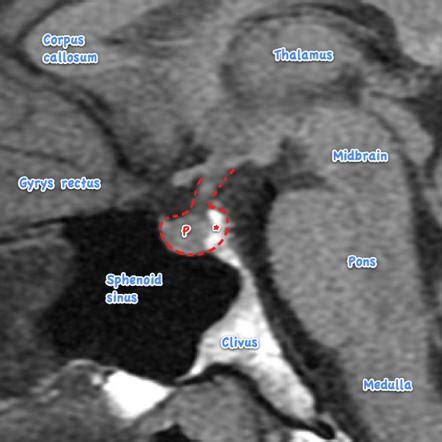 Pituitary Adenoma Ct Scan