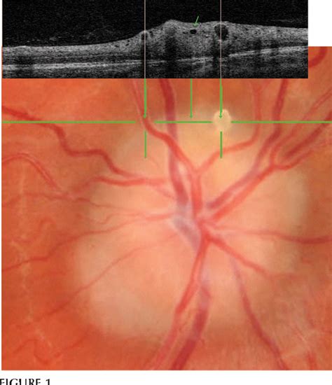 Optic Disc Drusen