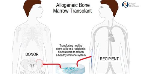 Bone Marrow Transplant: What it is, when and how it is done